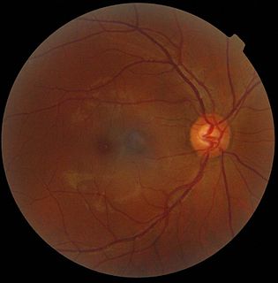 Optic disc Optic nerve head, the point of exit for ganglion cell axons leaving the eye