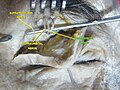 解剖中的眶上動脈