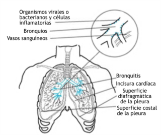 Bronquitis: Clasificación, Causas, Síntomas y signos