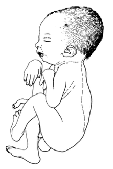 رسم لمولود مصاب باعوجاج المفاصل الخلقي المتعدد