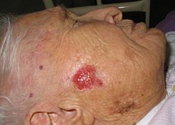 סרטן עור מסוג קרצינומה של תאי בסיס