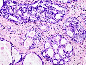 Brustkrebs: Epidemiologie, Ursachen und Risikofaktoren, Einfluss der Ernährung