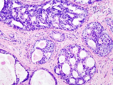 Carcinome canalaire in situ