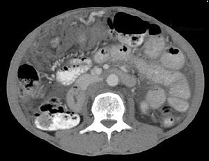 Fig. 8. Omental cake. Axial CECT image of a 55 year old female patient with carcinoma stomach showing peritoneal carcinomatosis in the form of omental cake (arrowhead).[1]