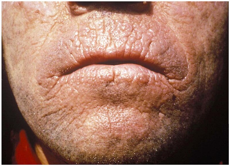 File:Chronic skin lesions of EPP.jpg