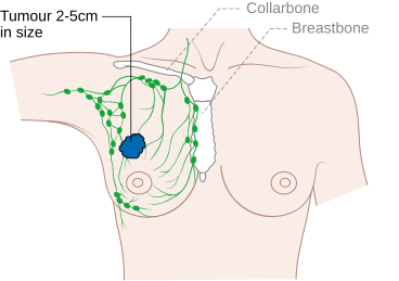 File:Diagram 2 of 2 showing stage 2A breast cancer CRUK 009.svg