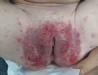 Diaper dermatitis complicated by Candida[6]