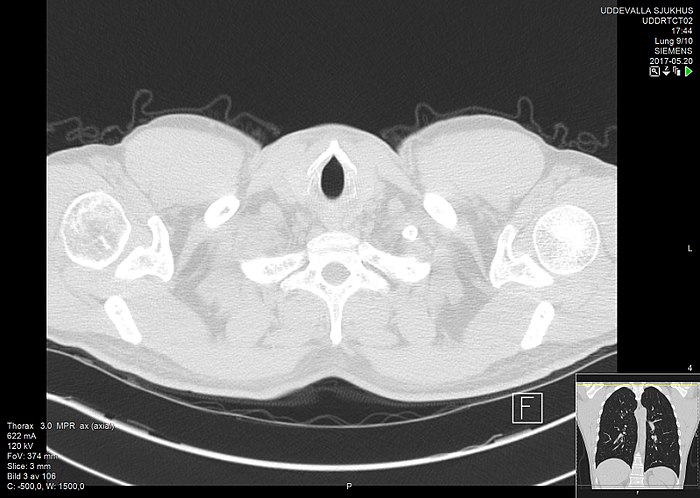 High-resolution computed tomograph of a normal thorax, axial plane (3).jpg