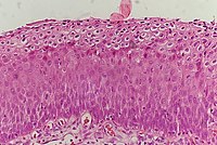 Istopatologia di CIN 3.jpg