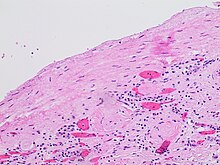 Histopathology of the lining of a simple cyst of the kidney, incidentally found on autopsy, with inconspicuous nuclei. They usually have a single layer of cuboidal, flattened or atrophic epithelium, but this case has a somewhat thicker fibrous layer. H&E stain. Histopathology of simple cyst of the kidney.jpg