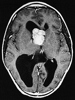 MRI of brain with sub-ependymal giant cell astrocytoma