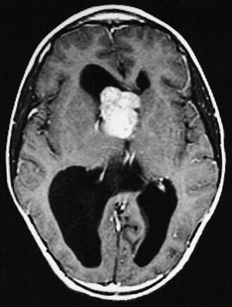 MRI of brain with sub-ependymal giant cell astrocytoma MRI of brain with sub-ependymal giant cell astrocytoma.jpg