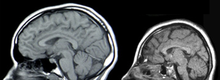 מימין - דימות של ראש אדם הסובל ממיקרוצפליה, ומשמאל - של אדם בריא.