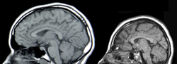 مسوح عصبية لجمجمة شخص مصاب بصغر الرأس (إلى اليمين) وجمجمة شخص طبيعي (إلى اليسار)
