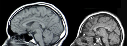 November 1: MRI scans of a microcephalic patient (right) and a healthy control (left).