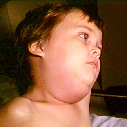 Child with mumps showing characteristic facial swelling