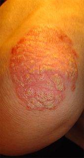 Intimbereich psoriasis Psoriasis im