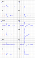 Thumbnail for Signal-averaged electrocardiogram