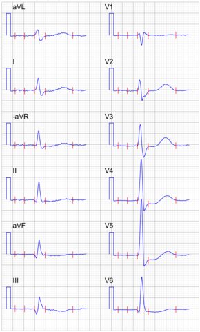 Signal-averaged ECG with digoxin.png