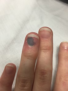 220px Subungal hematoma of the finger