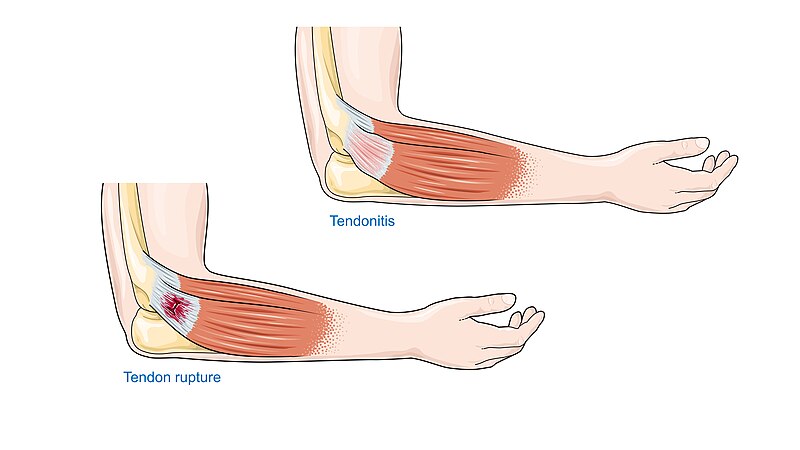 File:Tendonitis Tendon rupture -- Smart-Servier (cropped).jpg