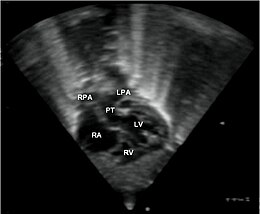 Görüntünün tanımı Transpozisyon büyük arterler Orphanet 1750-1172-3-27-1.JPEG.