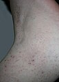 Uric acid skin rash.jpg