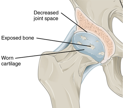 Annotated illustration of hip joint with osteoarthritis