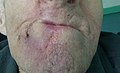 Abbe-Estlander flap 12 days after 1st op.jpg