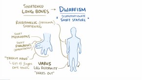 ملف:Achondroplasia.webm