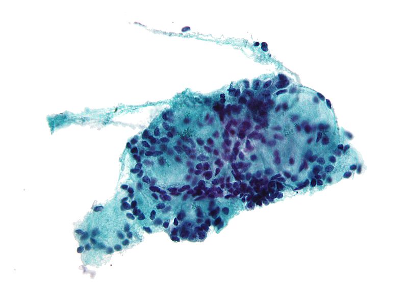 File:Adenoid cystic carcinoma cytology.jpg