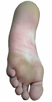 Visible welts typically sustained from foot caning Bastinado visible aftereffects.JPG