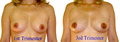 Breast changes in pregnancy.