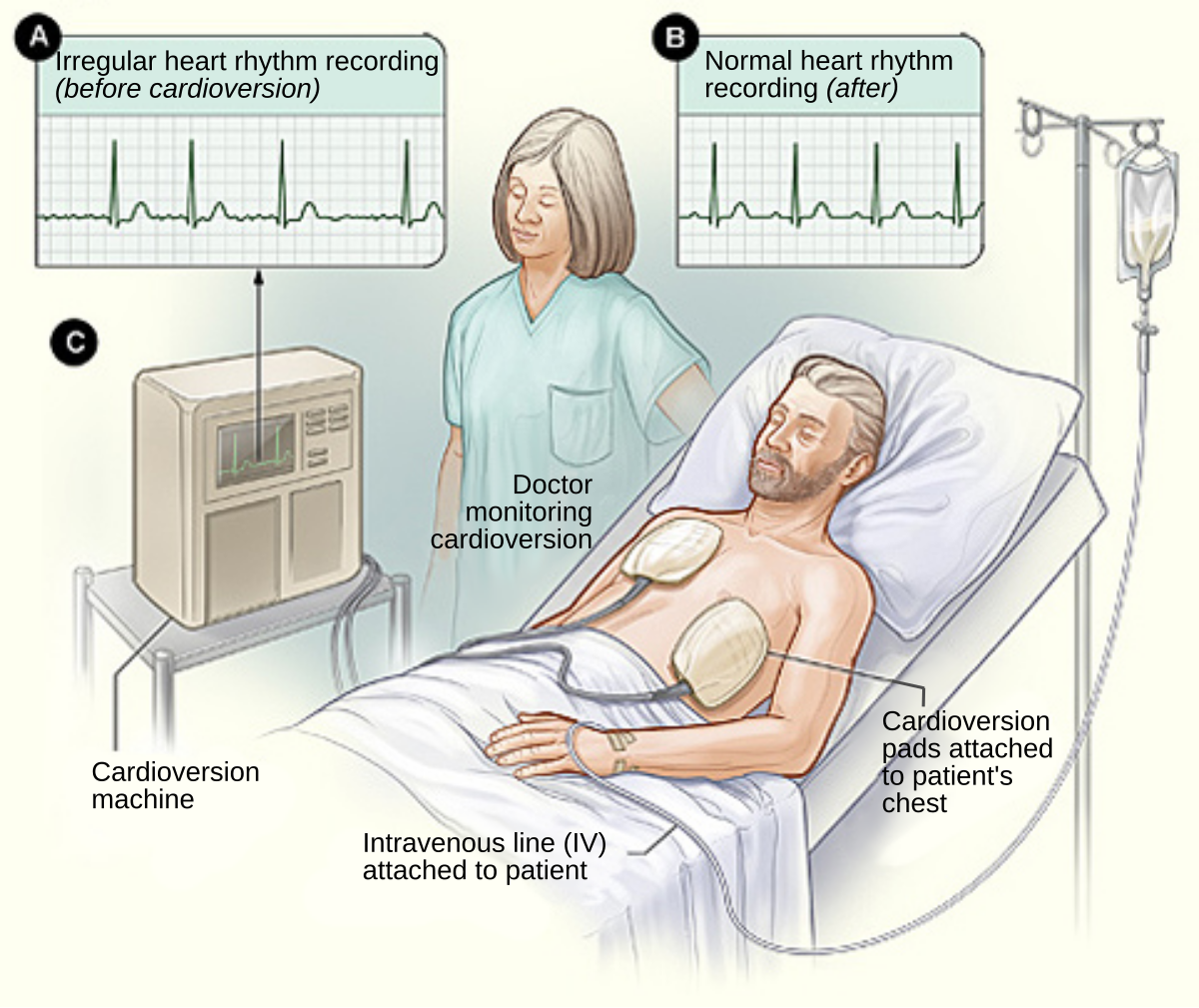 Cardioversion électrique : comment ça se passe ?