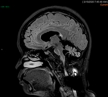 Cerebellar atrophy in MSA-C.png