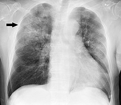 Chest X-ray of a case of Haemophilus influenzae, presumably as a secondary infection from influenza. It shows patchy consolidations, mainly in the right upper lobe (arrow).