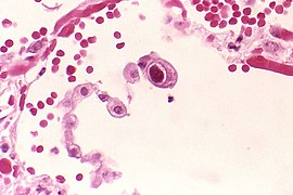 Cytomegalowirus w płucach.jpg