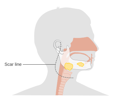 File:Diagram showing the scar line after removal of the parotid gland (parotidectomy) CRUK 369.svg