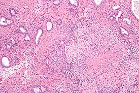 Гранулёматозный простатит вследствие лечения рака мочевого пузыря вакциной БЦЖ