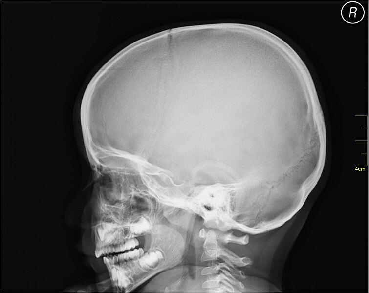 File:Medical X-Ray imaging PVG06 nevit.jpg