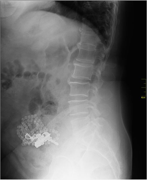 File:Medical X-Ray imaging XHM07 nevit.jpg