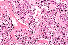 Medullary thyroid carcinoma - 2 - high mag.jpg