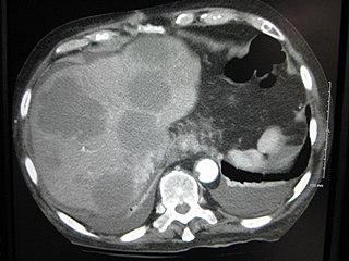 Metastatic liver disease