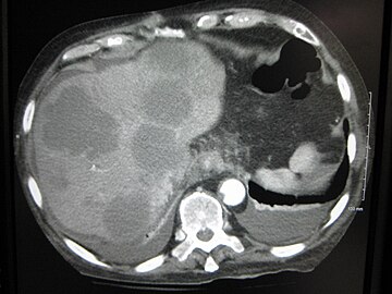 CT image of multiple liver metastases