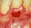 Thumbnail for Plasma cell gingivitis