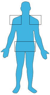 Polymyalgia rheumatica