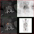Vergleich derselben Läsion des vorgenannten Patienten: Die FDG-PET/CT-Aufnahme zeigt die Stoffwechselaktivität des Tumors.