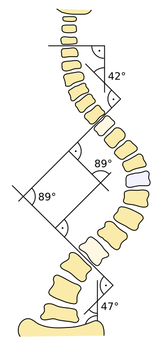 <span class="mw-page-title-main">Cobb angle</span> Measurement of scoliosis