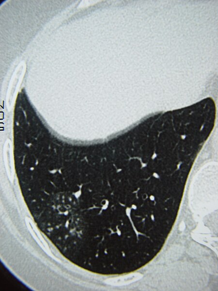 File:Systemic sclerosis case 11 pic 05.jpg