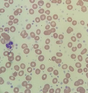 Thrombocytosis blood smear.jpg